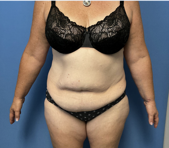 Tummy-Tuck-with-Liposuction--Case-Study-2958 | Before Liposuction